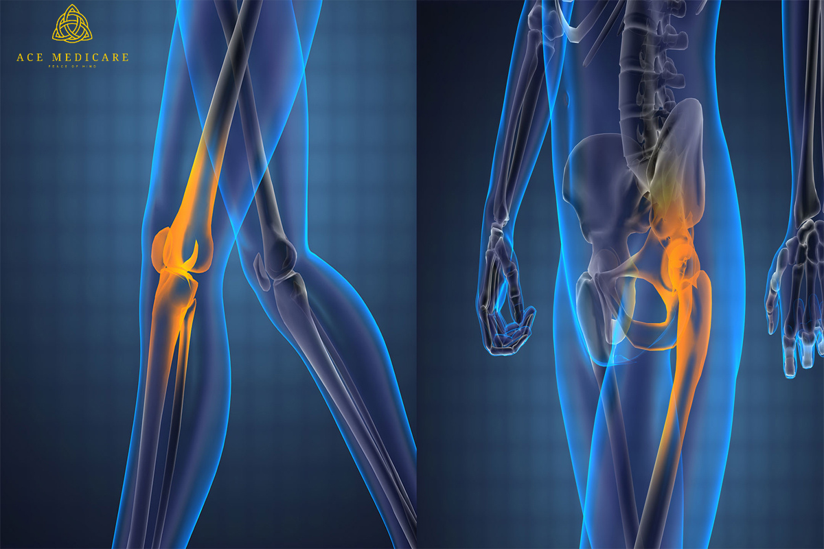 The Basics of Knee Replacement Surgery: A Comprehensive Guide